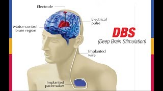 DBS (Deep Brain Stimulation)