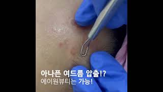 안아픈 여드름 관리 방법? #강남피부관리 #대구피부관리 #구미피부관리