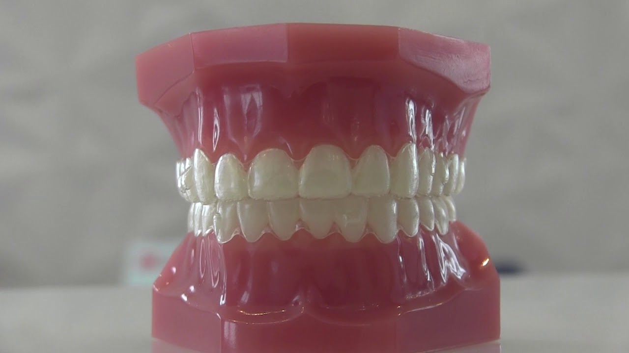 Alinhadores transparentes Invisalign: saiba como funciona esse aparelho dental invisível