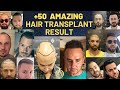 50 amazing hair transplant result