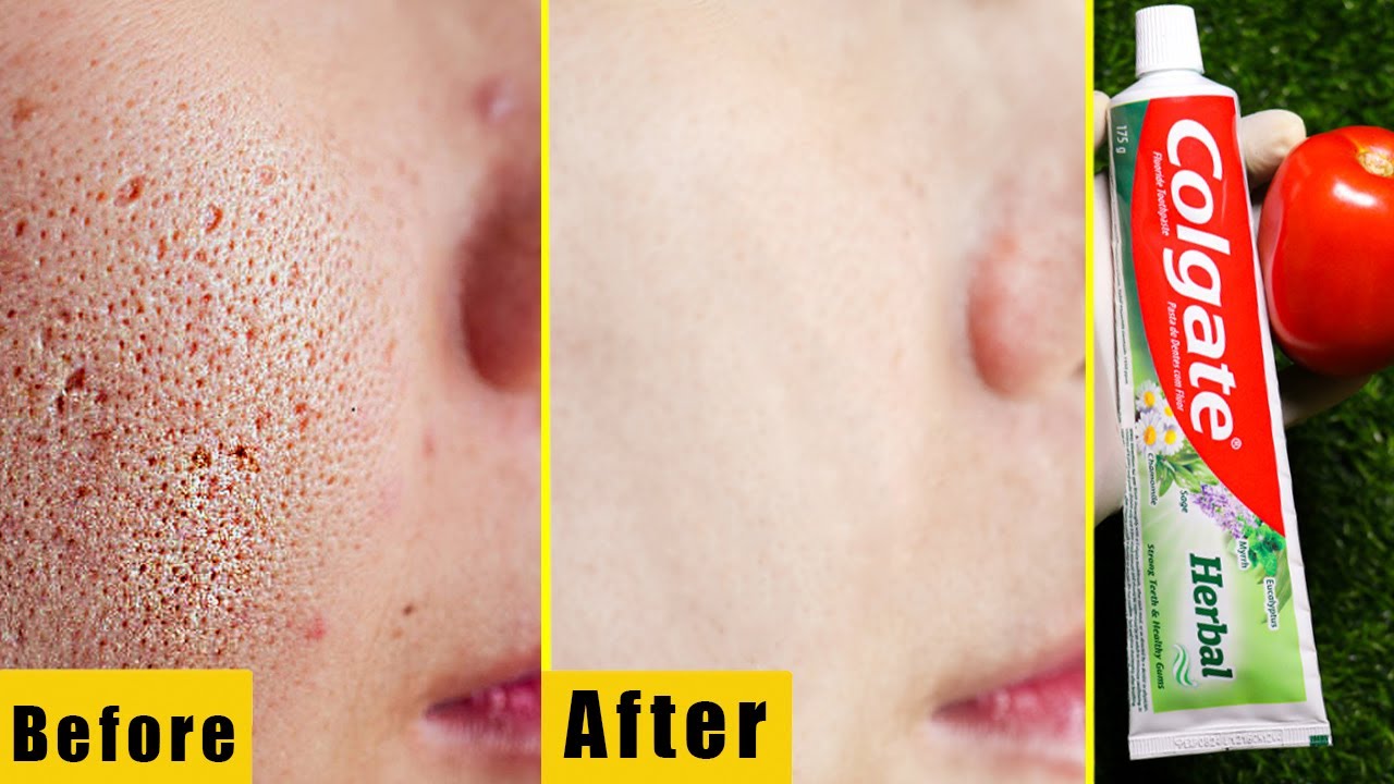 Try Skin Whitening with Colgate, Tomato and Citrus You Will Thank Me ...