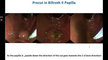 ERCP & Sphincterotomy in Billroth II Anatomy