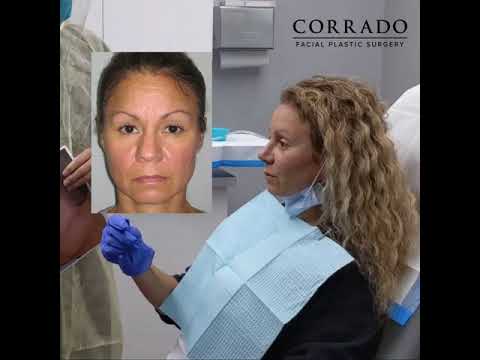 Video thumbnail: Rhinoplasty Reveal 1 Week Post Op: "Wow! It Has A Shape, Finally!" | Dr. Anthony Corrado · Dr. Anthony Corrado