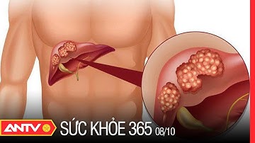 Dấu Hiện Nhận Biết Bệnh Xơ Gan Và Cách Điều Trị | Sức Khỏe 365 | ANTV