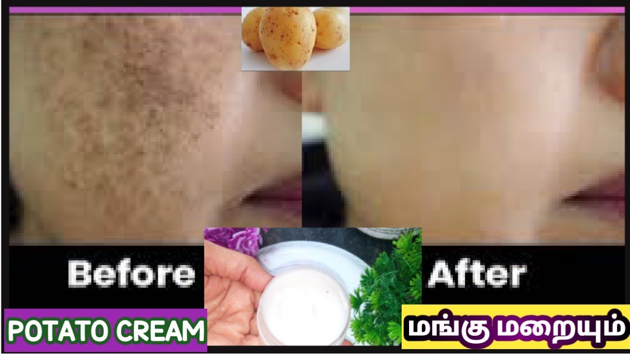 Pigmentation Dark Spots Melasma மங்கு 100 Working Cream Diy Magical