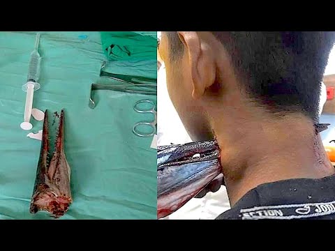 10 Surprisingly Vicious Fish Attacks - 10 Surprisingly Vicious Fish Attacks