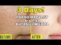 HOW TO GET RID OF LARGE OPEN PORES PERMANENTLY IN 3 DAYS