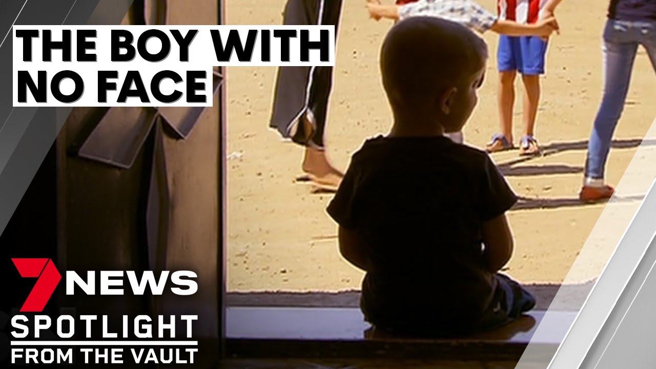 The Boy With No Face: The Incredible Story Of Yahya | 7News Spotlight