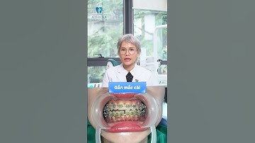 NIỀNG RĂNG CẤP TỐC ĐIỀU TRỊ KHỚP CẮN NGƯỢC