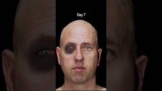 Black Eye Facial Trauma Time Lapse Healing. #blackeye #facialfracture #nasalfracture #brokennose