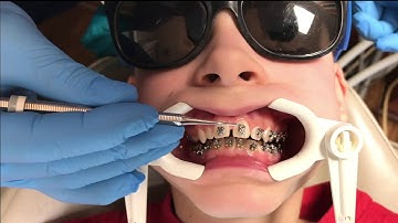 DPD Smiles Easy Braces!