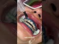 teeth whitening process 🦷 #teethwhitening#teethwhiteningprocedure