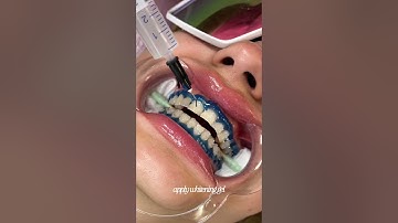 teeth whitening process 🦷 #teethwhitening#teethwhiteningprocedure