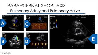 Paraesternal Short Axis - Echocardiography guide of the step by step