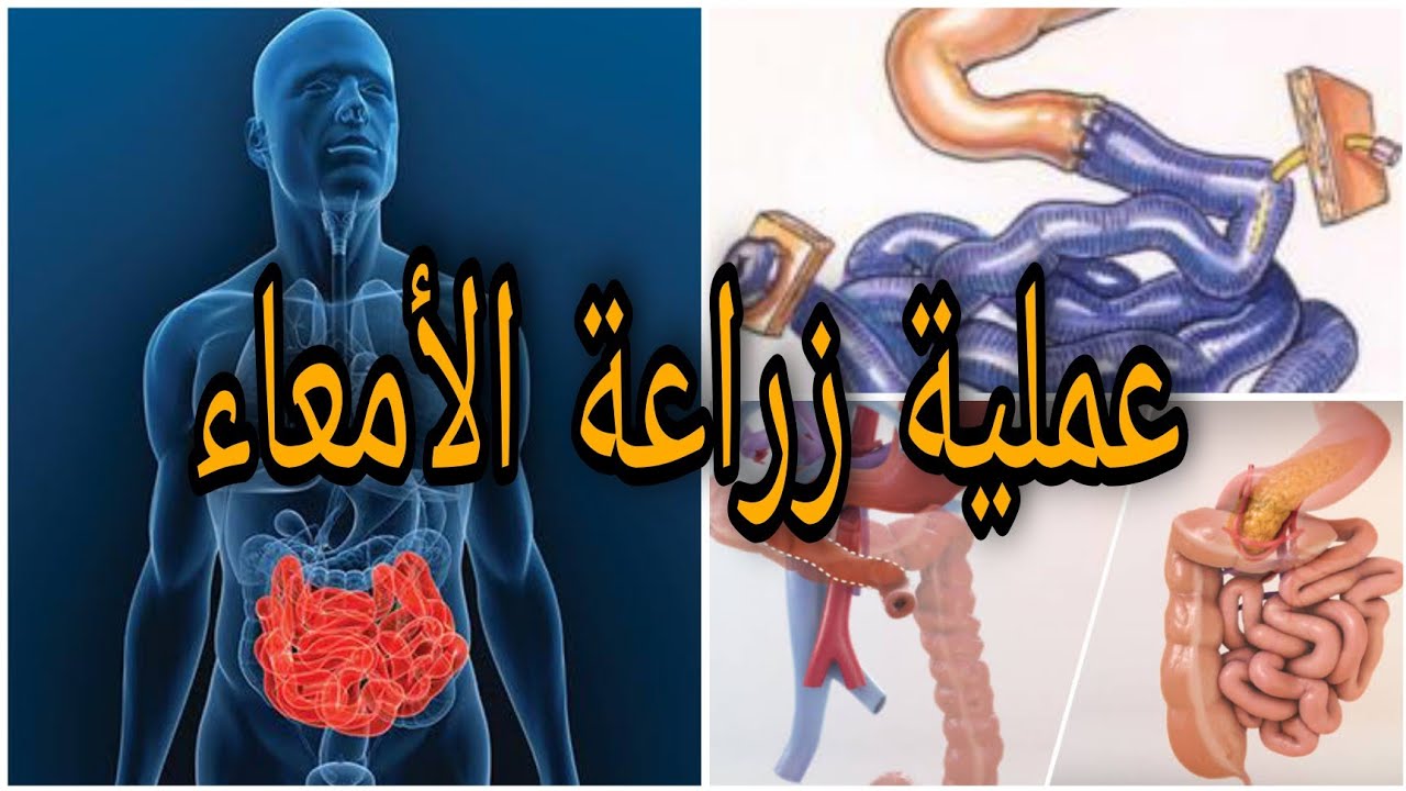 زراعة الأمعاء||بارقة أمل لبعض المرضي||لماذا يتم عملها وكيف يتم إجراؤها