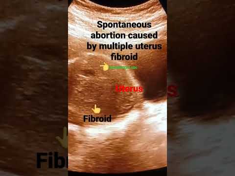 ቪዲዮ: Subchorionic hemorrhage ህመም ሊያስከትል ይችላል?