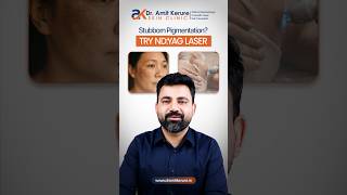Nd:YAG Laser for Pigmentation & Dark Spots | Dermatologist in Vashi