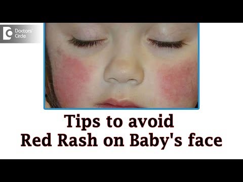Baby cheeks red and dry in winter |Causes & Remedies - Dr. Rashmi Ravindra | Doctors&rsquo; Circle