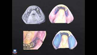 IMPRESSION TECHNIQUES & JAW RELATIONS IN REMOVABLE PARTIAL DENTURES