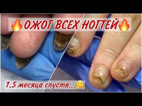 Ожог ногтевой пластины 🔥 ЧАСТЬ 3 ❤️ Онихолизис, акриловая пудра и лак для ногтей.