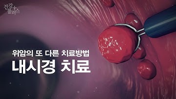 내시경을 통한 위암 치료 [건강플러스]