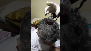 كيفية تثبيت كأس الحجامة على الشعر الكثيف مع الباحث والاخصائي سامح أبوخضرة 01099979407