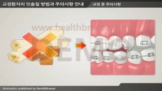 [시연용] g0088aako 교정환자의 잇솔질 방법과 주의사항 안내