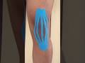 Mild knee swelling | Try this Taping Technique… #taping #physio #exercises #lifestyle #kneepain