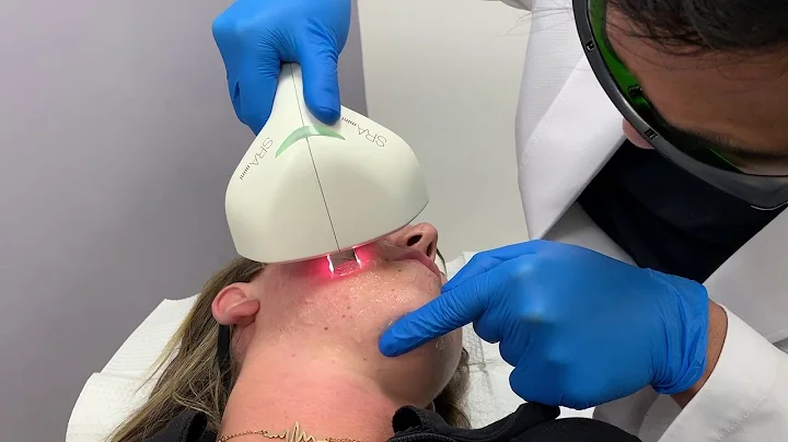 IPL (Intense Pulsed Light) treatment for skin rejuvenation and sundamage by Dr. Shaun Patel in Miami