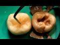 реставрация жевательного зуба