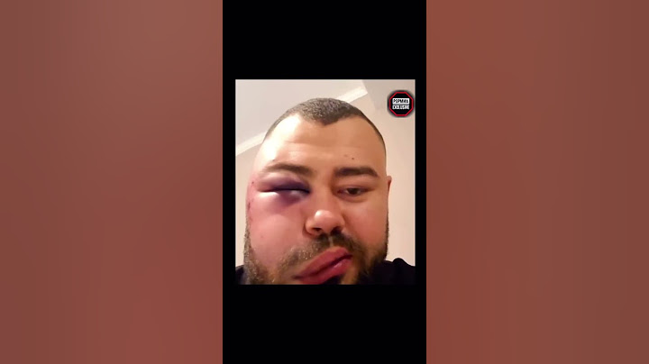 😳Так выглядит лицо чемпиона по пощёчинам спустя сутки #shorts #popmma #viral