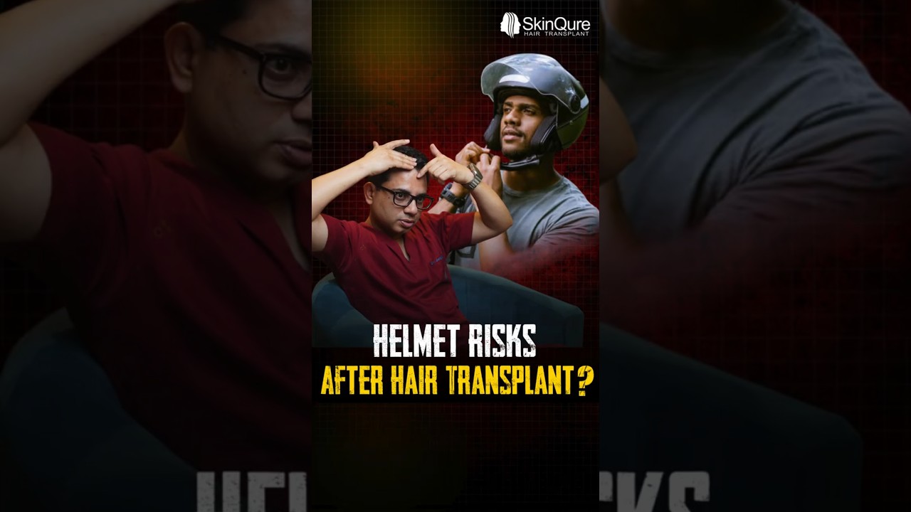 When to wear a helmet after hair transplant? | Learn from Hair Transplant Surgeon