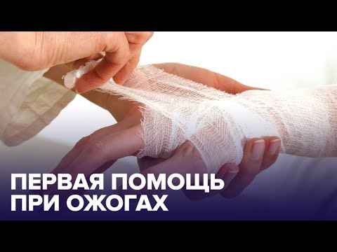 Первая помощь при ОЖОГАХ: как ее оказывать?