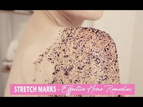Video: Cara Mencegah Stretch Marks: 7 Petua