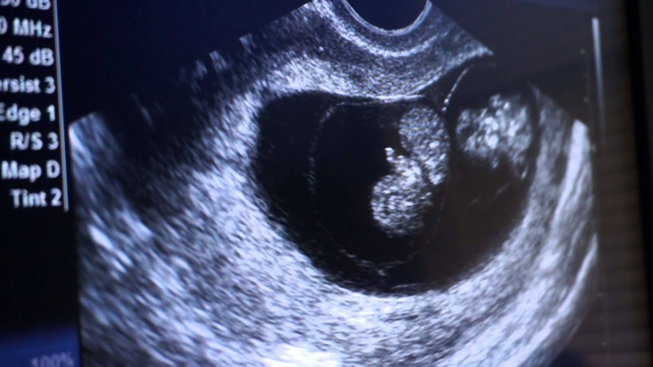 8 week ultrasound fraternal twins