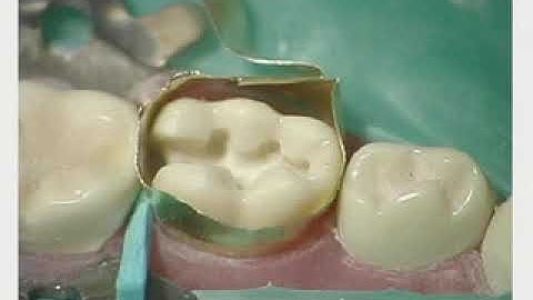 Tooth Preparation and Class II Amalgam Obturation