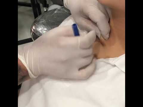 Dermal piercing nasıl yapılır