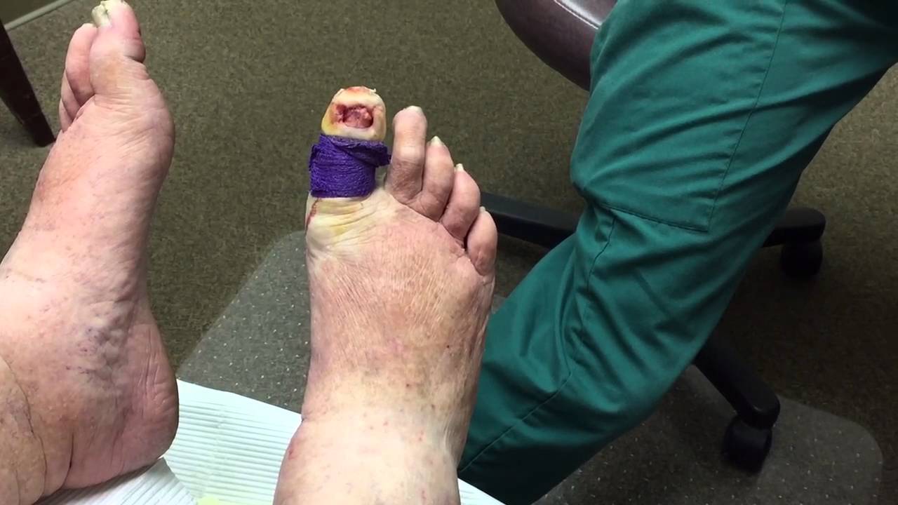 Ingrown Toenail Surgery | Sole Podiatry