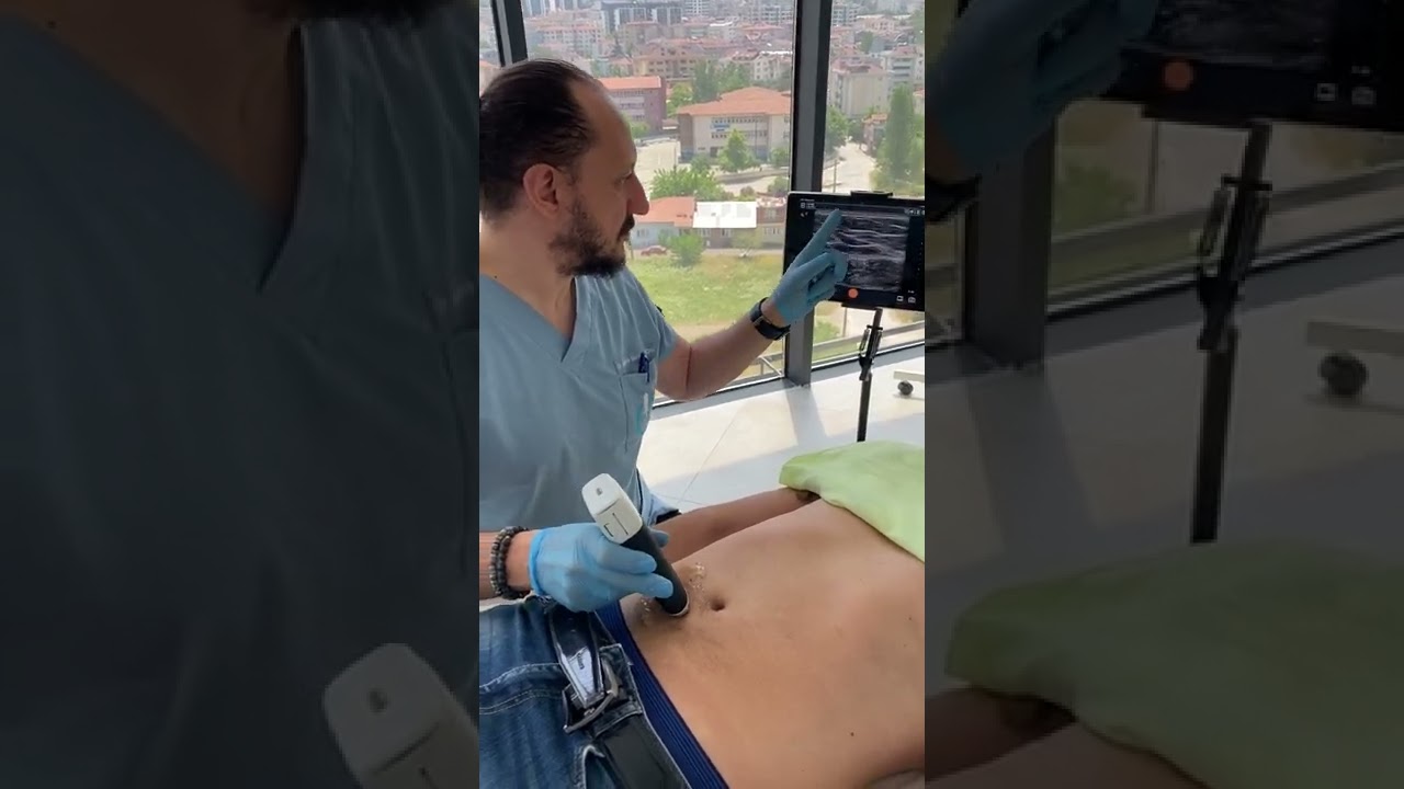 Karın Ağrısı, Anterior Cutaneus Nerve Entrapment Syndrome (ACNES) -2 (Ultrasound)