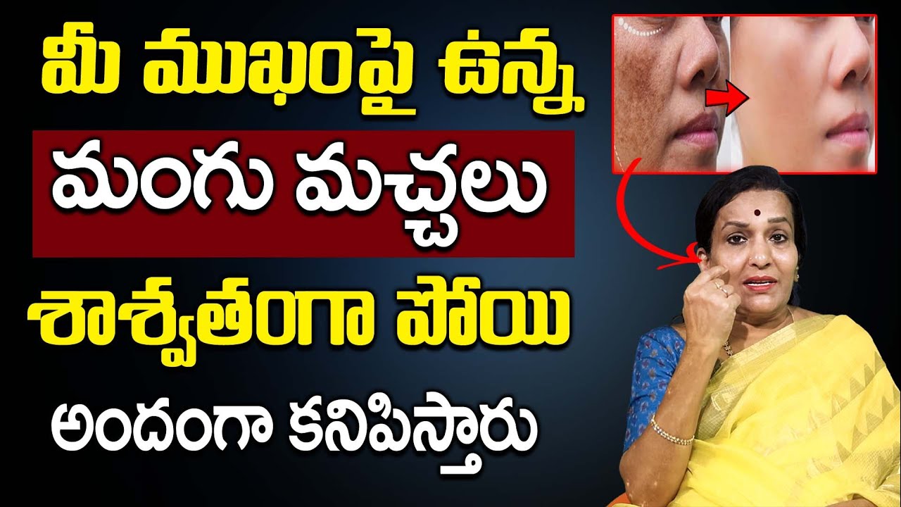 Dr L  Umaa Venkatesh _ Permanent Soloution For Pigmentation in Telugu || How to Remove Mangu Machalu