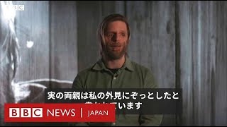 「ぞっとする」外見のため生後36時間で捨てられた男性　憎んでいた顔を誇りに思うまで