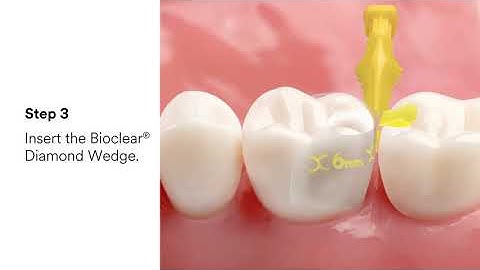 3M™ Filtek™ Dental Restoratives and Bioclear®