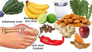 [GOUT TREATMENT] How To Cure Gout Fast At Home With Natural Remedies | Health 24H