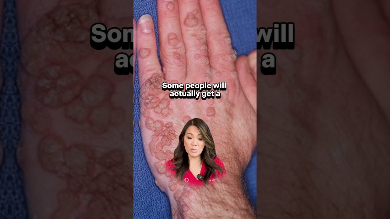 Warts Are Contagious