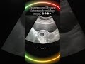 #blessed_way_in_jesus #pregnancy #blessed #miracle