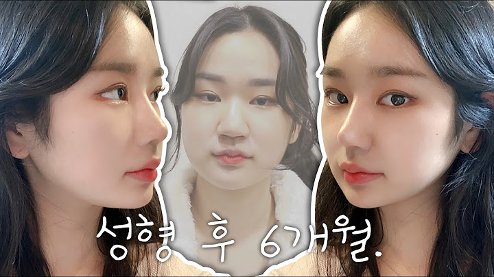 쌍수의 종지부를 찍고 왔다❗ 눈 재수술 & 코 성형 & 심부볼 제거 6개월 후 모습👀 처음 해보는 코수술부터 마지막 눈 재수술까지 다 털어옴😎 [쀼]
