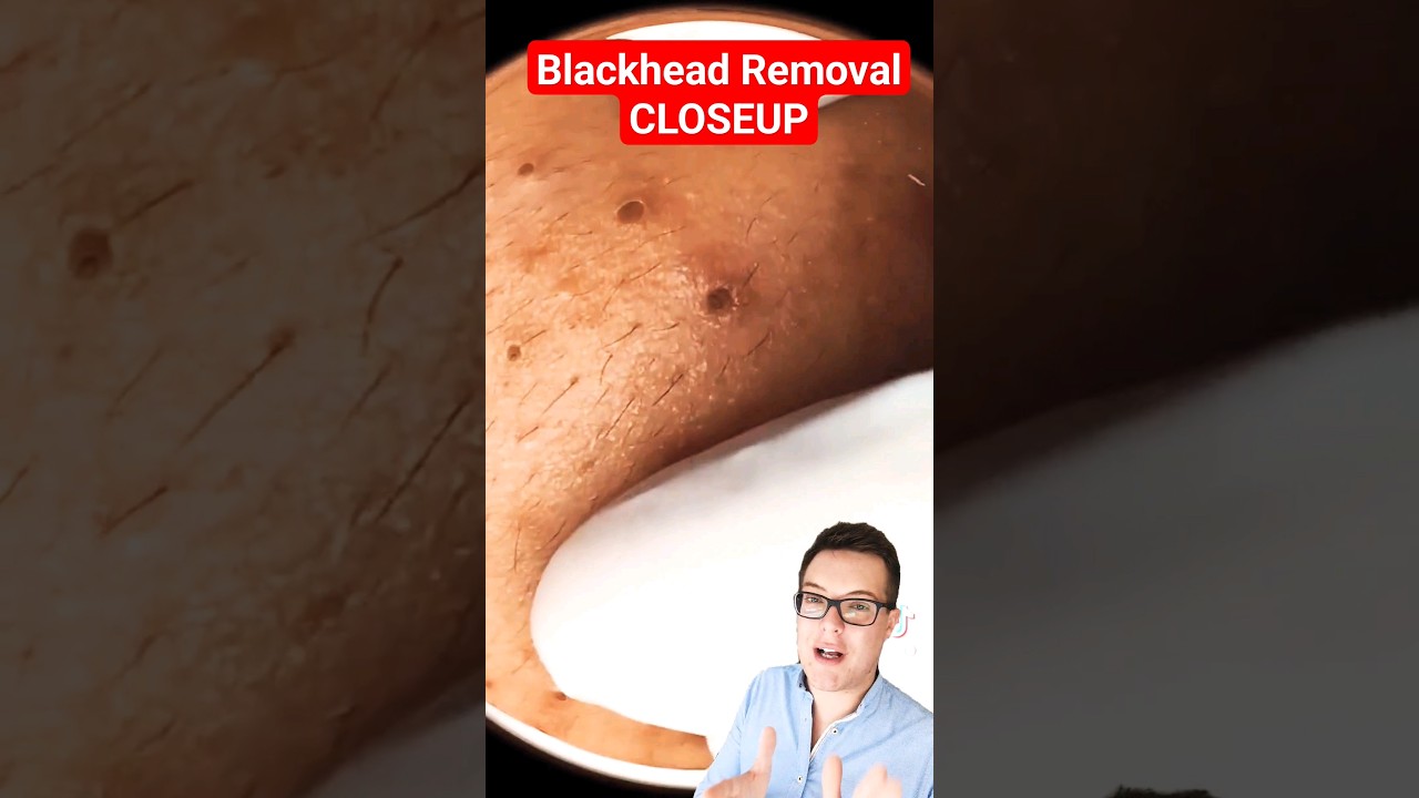 CRAZY CLOSEUP BLACKHEAD REMOVAL #shorts