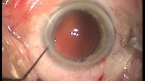 Injection of a CTR using the 