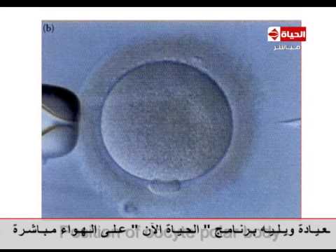 العيادة د مؤمن كامل بالصور خطوات الحقن المجهري