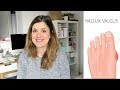 3 ANS APRÈS | Mon opération du pied : hallux valgus & rigidus